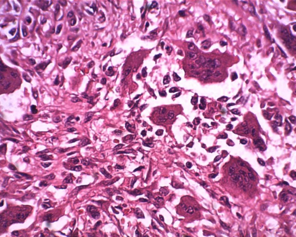 Giant cell tumor of tendon sheath under high power (40X, H/E) :shows an admixture of polygonal and spindle shaped mononuclear cells, xanthoma cells, multinucleated gaint cells in a collagenous, variably hyalinised stroma was seen .